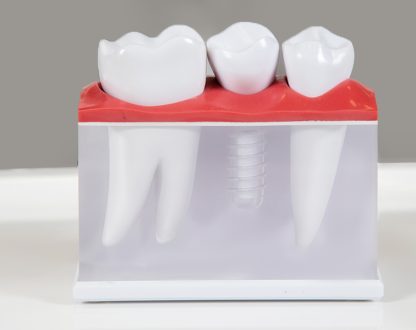 What Not to Eat After Dental Implant Treatment